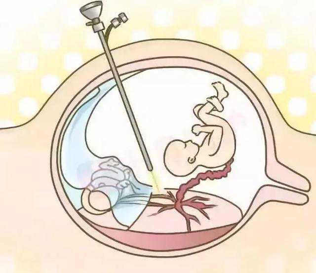 精囊炎可以吃生蚝吗